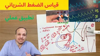 ضغط الدم الشرياني عبر الخط الشرياني                   شرح نظري وعملي دندنها