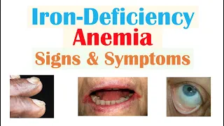 Download Iron-Deficiency Anemia Signs \u0026 Symptoms (ex. Fatigue, “Spoon Nails”, Cracked Lips) MP3