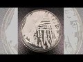 Drug-resistant fungus Candida auris spreading across US doctor says healthy people face low risk