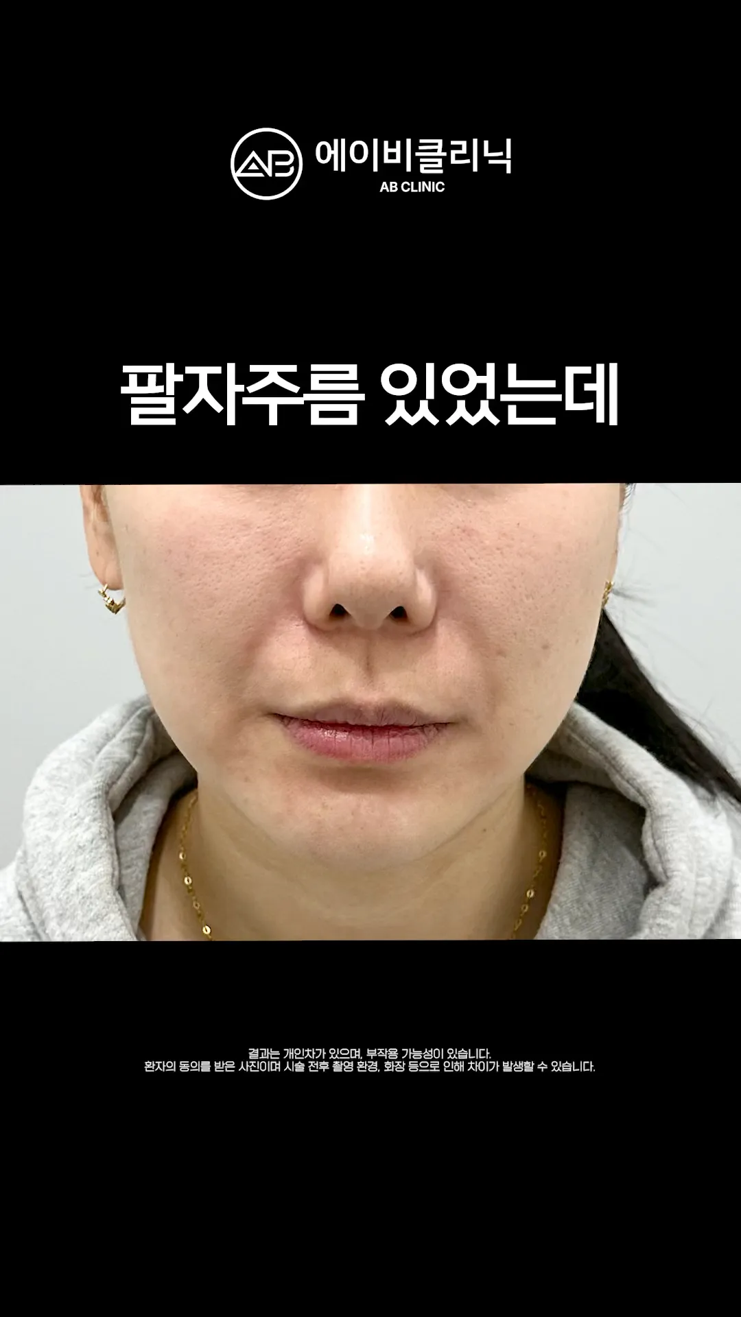 팔자주름 5분만에 지우는 법 👋