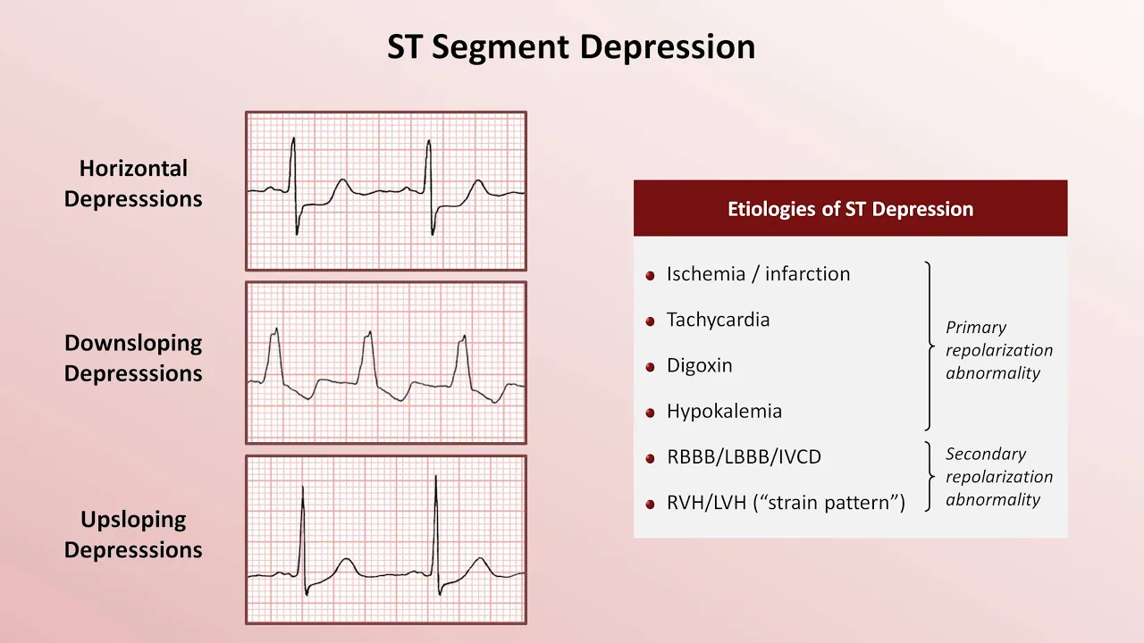 Intro to EKG Interpretation - QRST Changes