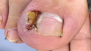 1 ano com a unha encravada (PARTE 1) 😱 #nails #satisfying