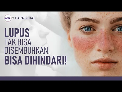 Cara Menghindari Lupus Jika Punya Faktor Keturunan