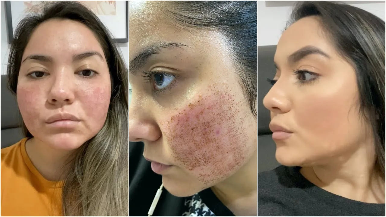 LIMPEZA DE PELE CASEIRA: REMOVE CRAVOS, PREVINE ESPINHAS E CLAREIA A PELE e OLHEIRAS | Gabe Zanqui
