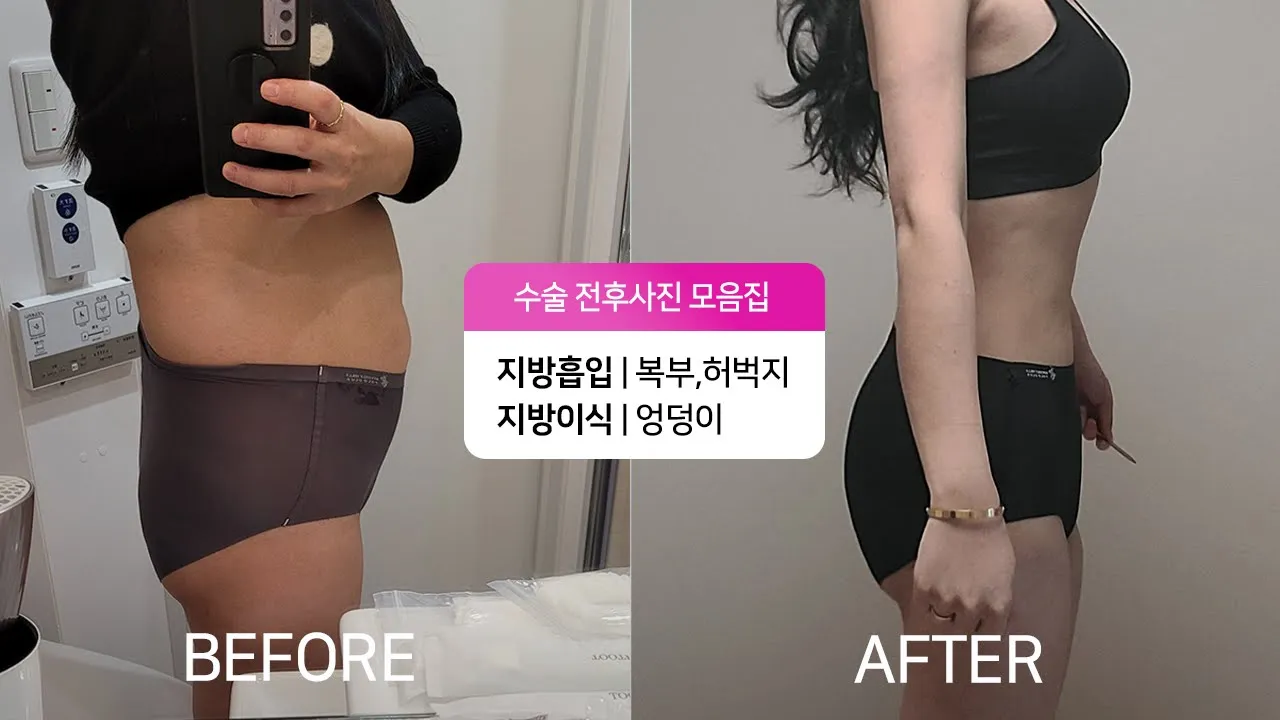 똥배 가리고 다녔는데 이제는 너무 행복해요💕 | 수술 전후사진 모음집