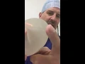 Episode 40 polyurethane implants how a breast implant can cause a breast lump and postop swelling