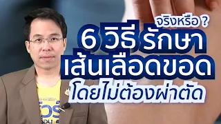  โรคหลอดเลือดขอดสามารถรักษาโดยไม่ต้องผ่าตัดได้หรือไม่ 