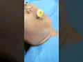 Goodbye Double Chin Chin Lipo results at Vive Plastic Surgery in