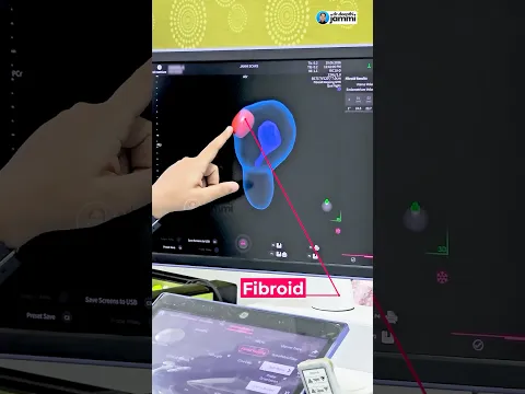 Fibroid Pain? This 3D Scan Shows the Real Problem!