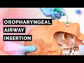 Oropharyngeal Airway Insertion Guedel OPA ABCDE Emergency OSCE Guide UKMLA CPSA PLAB 2