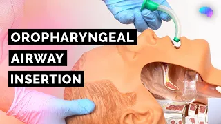 oropharyngeal airway insertion guedel opa abcde emergency osce guide ukmla cpsa plab 2