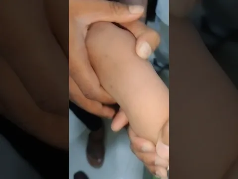 How to insert a Cannula?, vigo लगाने का सही तरीका, vigo step by step guide #shorts #vigo #viral