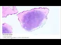 Dermatofibrosarcoma protuberans - Virtual microscopy Talking slide
