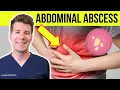 Doctor explains Abdominal Abscess Causes Symptoms Diagnosis
