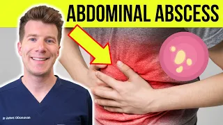 Doctor explains Abdominal Abscess Causes Symptoms Diagnosis