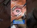 Download Lagu Live Contoura Topo-guided Lasik Surgery