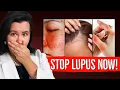 LUPUS blootgelegd in 10 minuten