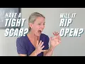 Download Lagu Is Tight Scar Tissue Limiting Movement of Your Hand or Finger? Get 3 Tight Scar Tissue Treatments