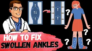 Download How to Get Rid of Swollen Ankles \u0026 Swollen Legs FAST [Causes \u0026 Fixes] MP3