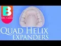 Quad Helix Expander for Braces Invisalign