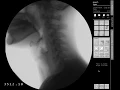 Consecutive Swallow - Thin with Penetration