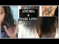 Anemia Hair Loss My Story and Recovery