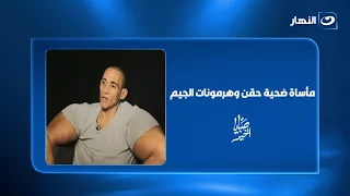 من عضلات ضخمة إلى تعفن الأنسجة.. مأساة ضحية حقن وهرمونات الجيم 😳