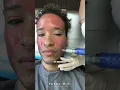 Download Lagu Microneedling with PRP for Acne Scars | Kami Parsa, M.D. #skincare #acnescars