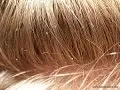 How To Get Rid Of Lice Quickly and permentantly