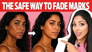 Professional Hyperpigmentation treatment Melanin-Rich skin