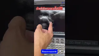  ทำไมถึงเกิดก้อนน้ำที่ข้อมือ และเกิดจากอะไร 