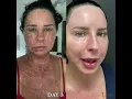 Download Lagu UltraClear Laser Weston Florida, Patient Discusses her recent treatment with 7 days of photos