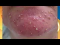 Dr Pimple Popper on how to identify your acne and the ways to treat it