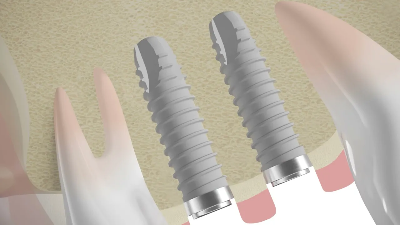 THOMMEN Medical Motion Graphics Teaser