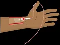 Arterial catheterization CPT code - simplify medical coding