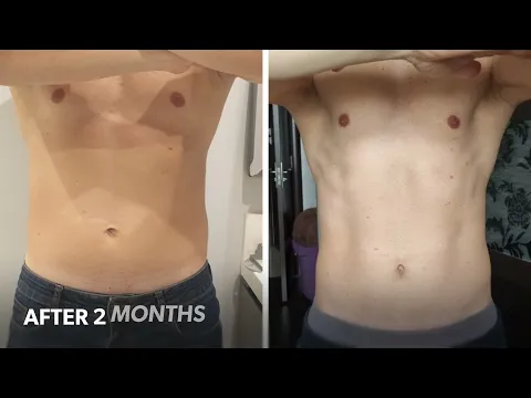 Download MP3 SculpSure Before & After 1 session