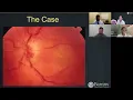 Lecture Approach to the Patient With Unilateral Optic Disc Swelling