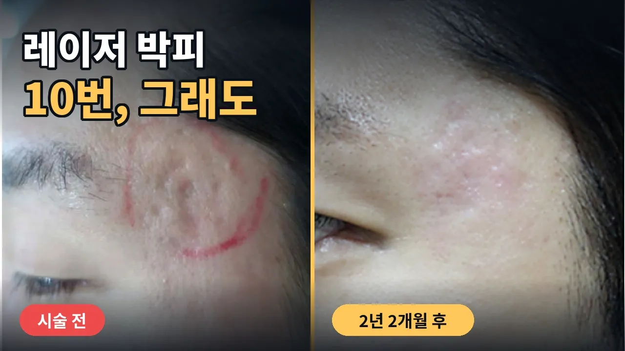 **여드름 흉터, 왜 레이저를 반복해도 그대로일까? | 기계적 박피술 2년 2개월 기록**#여드름흉터 #여드름관리#연세자연미#신촌성형외과