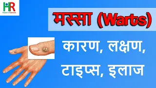  warts in hindi 