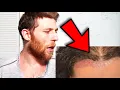 Hair Systems Dermatitis Best Hair System For Sports
