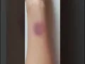 How to create fake bruises fake injury