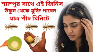 5 মিনিটে উকুন থেকে মুক্তির উপায়,Use this along with shampoo to get rid of head lice.