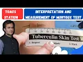 Tuberculin skin test measurement and interpretation positive PPD montoux test patient tuberculosis