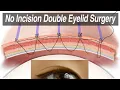 Non-Incisional Asian Double Eyelid Surgery Suture Technique for Monolid Correction Animation