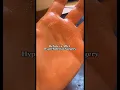 Download Lagu Before v After Hyperhidrosis Surgery for excessively sweaty hands #excessivesweating #hyperhidrosis