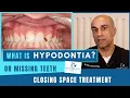 How To Fix Missing Teeth with Braces