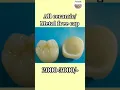Download Lagu Types of dental caps/crown and cost