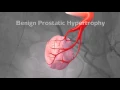 Research Study for Men 45-80 with Enlarged Prostate