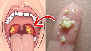ما هي حصي اللوزتين وكيف يتم أزالتها What Is Tonsil Stones 