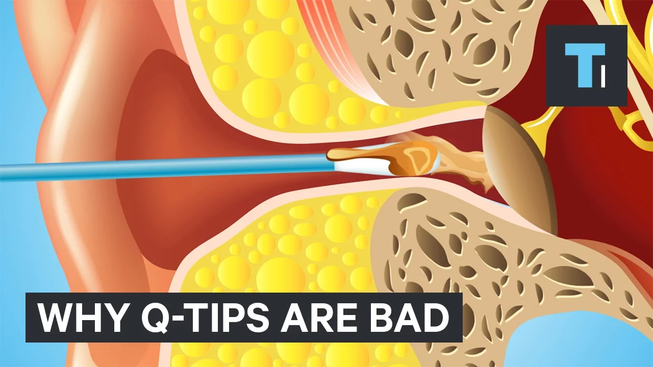 NYU Otologist Erich Voigt explains the proper way to clean wax out of your ears. Many people think Q. 